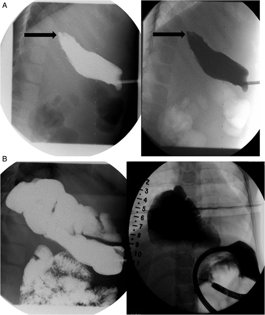 (A) Lateral view during her initial fluoroscopic examination illustrating a small, distal (lower) esophageal remnant present in situ (Black arrows). Contrast was injected through her existing gastrostomy tube. (B) Anterior–posterior (AP) view during initial fluoroscopic examination illustrating an aperistaltic, native colonic interposition in situ with significant dilatation.