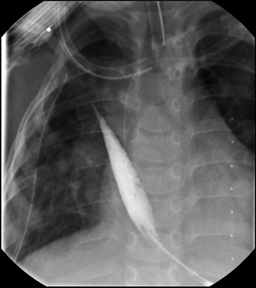 Fluoroscopic examination illustrating incremental ‘growth’ of the distal (lower) esophageal segment while the patient was undergoing external traction (Foker Stage 1). The contrast was injected through her existing gastrostomy tube. The metal dot refers to her esophagostomy; thus, can measure the distance between the ends of her esophageal segments.