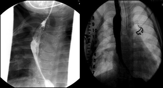 An intraoperative esophagram following a routine esophagogastroduodenoscopy (EGD) is pictured on the right, as compared with her postoperative esophagram on the left. The EGD was performed on this patient following her anastomosis (Foker Stage II); the native esophagus was now in continuity. Contrast was injected above the level of the anastomosis, which demonstrated neither leak nor stricture.