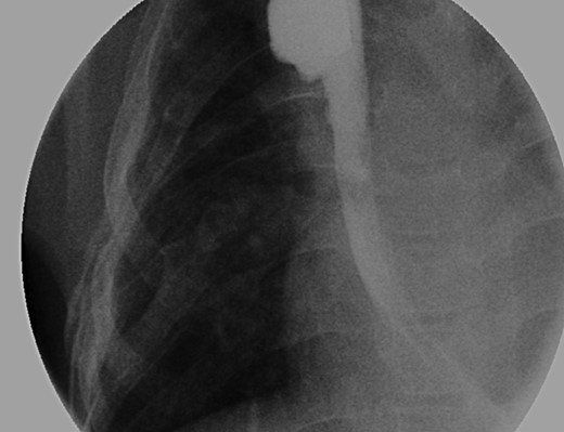 Her last follow-up EGD demonstrating a patent native esophagus.