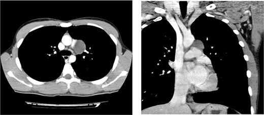 Preoperative chest CT scan showing a cystic mediastinal mass adjacent to the left pulmonary artery and aortic arch.