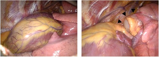 Intraoperative thoracoscopic images. Complete absence of the left pericardium (left) and cystic mass (arrow heads) arising from the middle mediastinum (right).