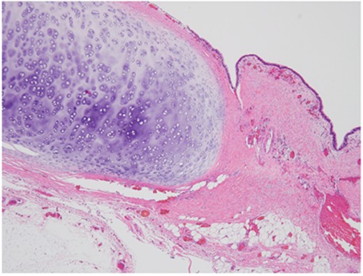 Microscopic view of resected bronchogenic cyst showing ciliated epithelium and cartilage (H&E stain, ×20).