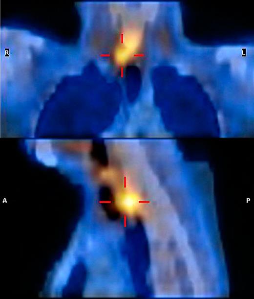SPECT scan demonstrating a right-sided parathyroid gland adenoma.