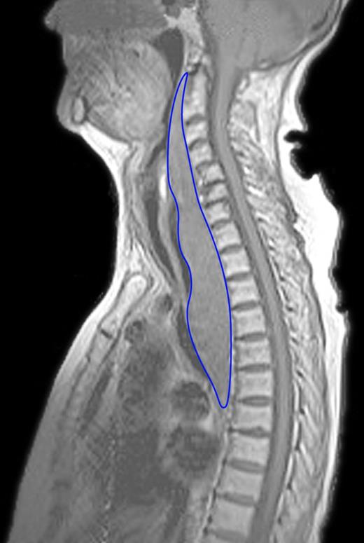 MRI showing the elongated retropharyngeal mass anteriorly of the spine, compressing the trachea and esophagus. The mass starts at the level of the second cervical vertebra and expands into the posterior mediastinum until the level of the seventh thoracic vertebra. Length of the hematoma is 200 mm with an anterior–posterior diameter of 33 mm. Compression of the trachea to a minimal diameter of 3 mm.