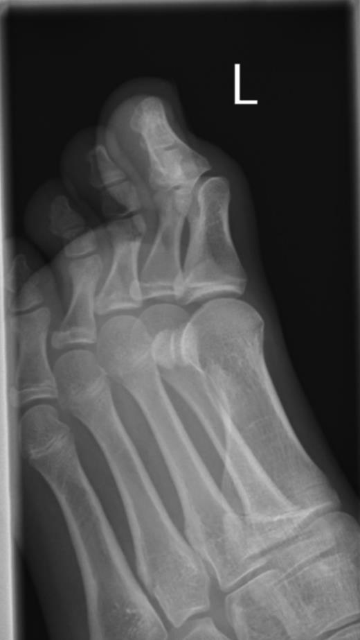 Plain radiograph showing plantar-flexed hallux IPJ.