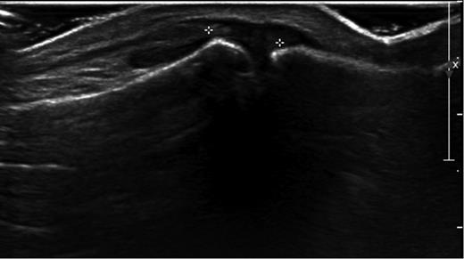 Ultrasound image showing ruptured IPJ capsule and avulsed EHL tendon.