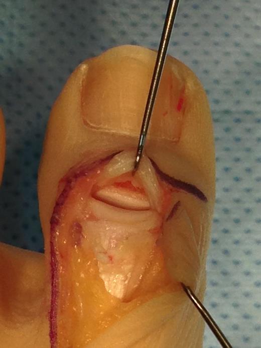 Operative photograph showing ruptured EHL tendon and avulsed IPJ capsule.
