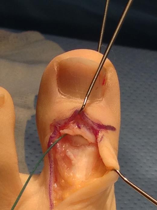 Operative photograph showing transfixion of the IPJ with a K-wire and insertion of a Mitek anchor into the distal phalanx.