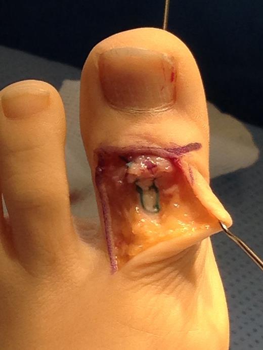 Operative photograph showing tendon repair and transfixion.