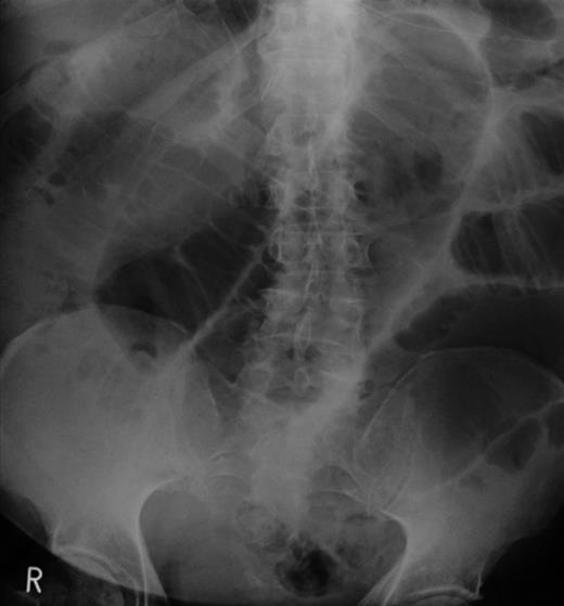Abdominal X-ray showing SBO.