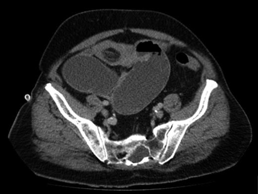 CT showing intussusception secondary to a lesion.