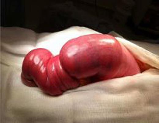 Excised intussusception.