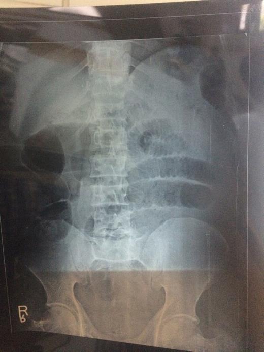 X-ray abdomen showing dilated small and large gut loops.