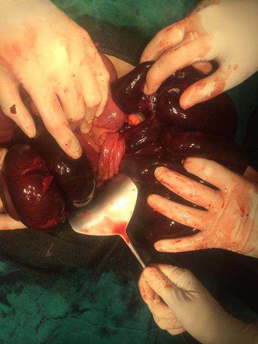 Intraoperative picture showing ileal knotting around sigmoid colon resulting in gangrene of both.
