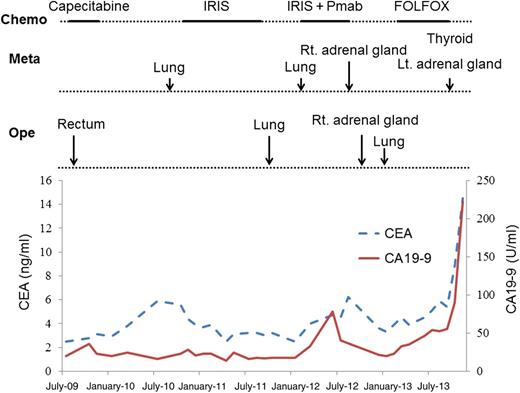 Clinical course and changes of tumor markers. CEA: carcinoembryonic antigen; CA19-9: carbohydrate antigen; Chemo: chemotherapy; Ope: operation; Meta: metastatic place; IRIS: irinotecan with tegafur–gimeracil–oteracil potassium; Pmab: panitumumab; FOLFOX: oxaliplatin with fluorouracil and folinic acid; Rt: right; Lt: left.
