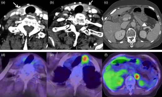 CT scans and PET scans of the neck and abdomen. (a and b) CT scan of the neck detected low-density nodules in bilateral lobes of the thyroid gland (arrows). (c) CT scan of the abdomen detected a low-density nodule with clear border in the left adrenal gland. (d) PET scan did not show abnormal uptake of 18FDG in the nodule in the right lobe of the thyroid gland. (e) PET scan showed abnormal uptake of 18FDG in the nodule in the left lobe of the thyroid gland. (f) PET scan detected abnormal uptake of 18FDG in the nodule in the left adrenal gland.