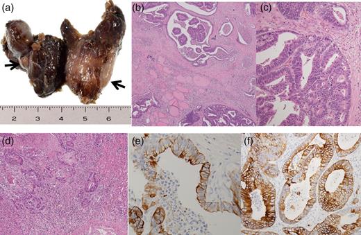 Pathological findings of resected thyroid gland. (a) Macroscopic findings of thyroid gland detected a nodule in each lobe (arrows). (b and c) Microscopic findings of thyroid gland detected adenocarcinoma consistent with metastatic rectal adenocarcinoma (original magnification, ×100 and ×200, respectively). (d) Microscopic findings of the left adrenal gland detected adenocarcinoma consistent with metastatic rectal adenocarcinoma (original magnification, ×100). (e) IHC staining of CK20 was positive in tumor cells of the thyroid gland (original magnification, ×400). (f) IHC staining of CK20 was positive in tumor cells of the left adrenal gland (original magnification, ×400).