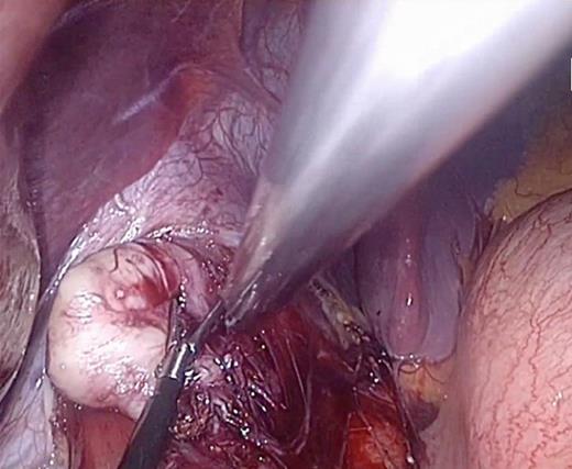 Oesophageal leiomyoma enucleated.