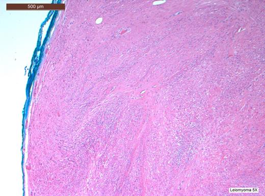 H&E stain at low power view revealing a tumour with a well-circumscribed edge with fascicles of spindle-shaped cells.