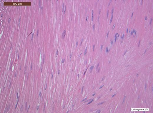 H&E stain at high power view showing spindle-shaped cells and perinuclear vacuoles, a characteristic finding of leiomyomas.