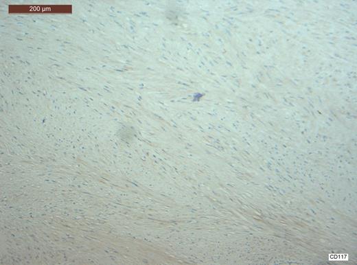 CD117 staining is negative hence excluding any possibility that this was a gastrointestinal stromal tumour (GIST).