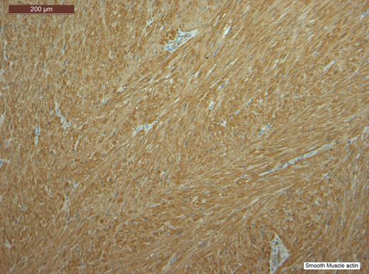 Stain positive for SMA.