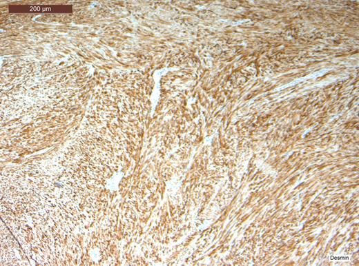 Stain positive for desmin.