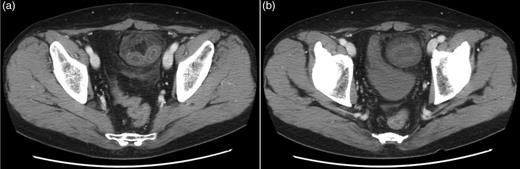 (a) Contrast axial CT shows a closed bowel loop with surrounding preperitoneal fat. (b) CT scans at the inguinal levels show the hernia sac and its contents compressing the urinary bladder, so that it shows a beak-like deformity.