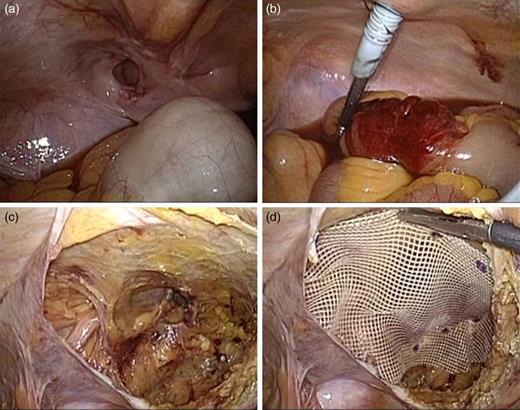 (a) Intraoperative photograph showing the hernia sac surrounded by a thickened peritoneum, extending into the preperitoneal space. The incarcerated bowel was released from the hernia sac naturally, after creating an artificial pneumoperitoneum under general anesthesia. (b) The viability of the incarcerated small intestine is confirmed, laparoscopically. (c) After the preperitoneal space was dissected, a hernia was detected in the left inguinal region; no concomitant hernia was observed. (d) The myopectineal orifice was covered with a 14 × 10 cm polyester mesh in the left inguinal region.