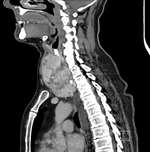 Sagittal CT image showing a thyroid goitre with retrosternal extension and paraoesophageal swellings.