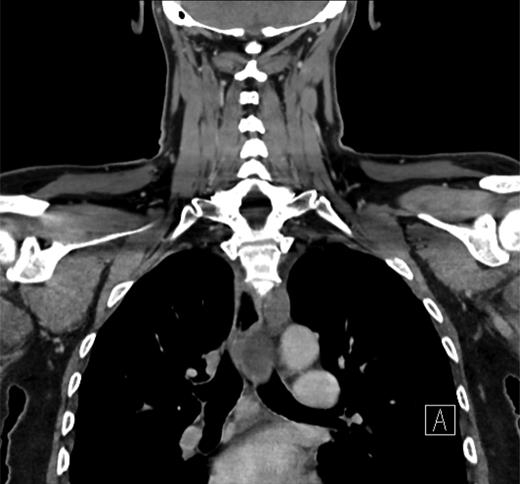 Coronal CT image of the mediastinum.