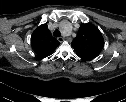 Axial CT image showing the thoracic duct cyst.