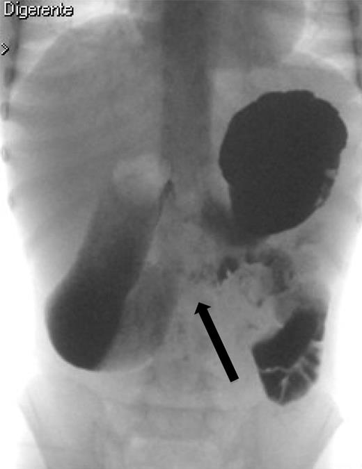 The upper gastrointestinal contrast study shows poor progression of contrast medium across duodenal obstruction. Arrow shows obstruction of the third duodenum.