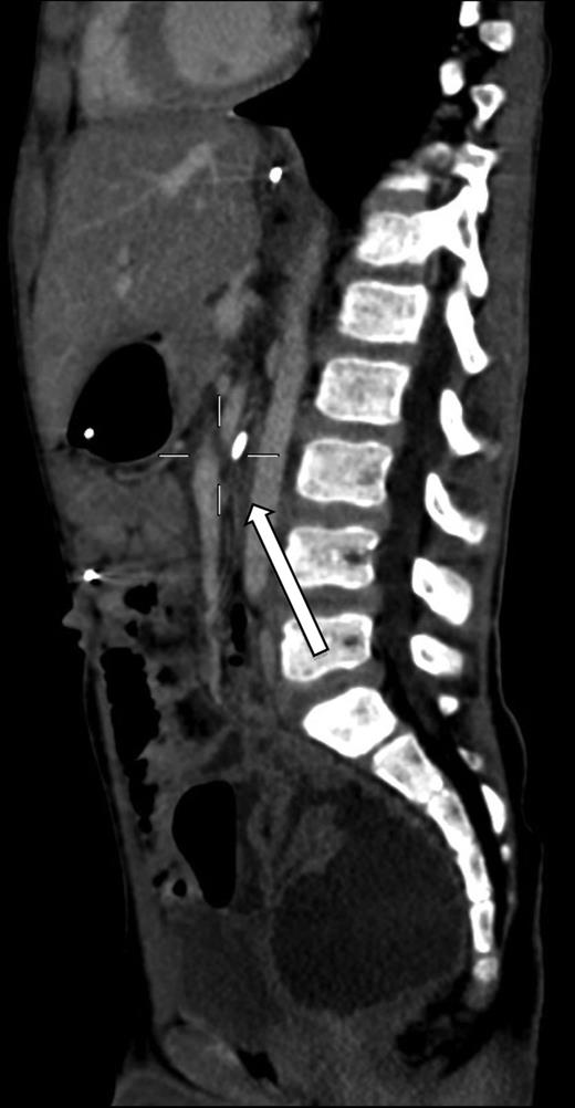 CT scan shows compression of the third duodenum by the SMA.