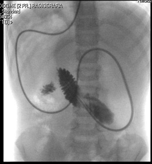 Correct position of the nasojejunal tube after endoscopic placement.
