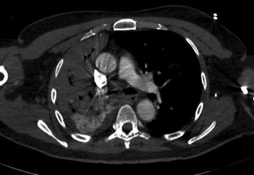 CT thorax—right-sided upper and mid zone collapse + consolidation.