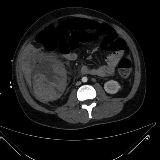 CT abdomen + pelvis with contrast: large inflammatory caecal mass.