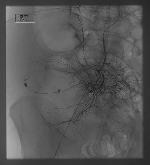 Angiography of the superior mesenteric artery.