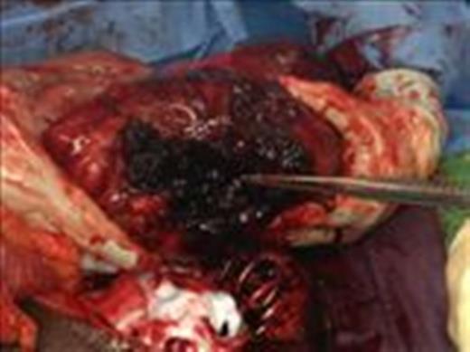 Grossly enlarged and perforated caecum with a suction device demonstrating the depth of the cavity.