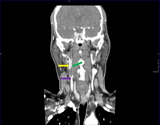 Sagittal plane view of the right carotid artery. Carotid bulb (purple arrow) gives rise to the internal carotid artery (yellow arrow) and an aberrant distal branch (green arrow).