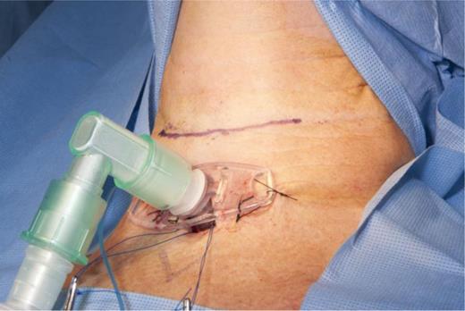 Tracheostomy prior to excision of the supraglottic mass to secure airway.