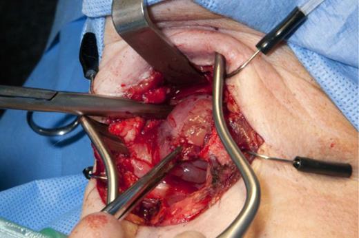 Supraglottic lesion via a laryngofissure approach.