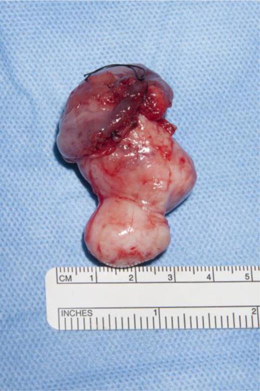 Supraglottic lesion sent for histology.