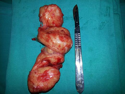 Final open prostatectomy specimen weighed as 540 g.