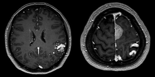 Axial T1-weighted gadolinium-enhanced MRI showing a 2.6-cm left parietal AVM located in the left angular/supramarginal gyrus (left) and an enhancing posterior frontal parafalcine meningioma in close association with the superficial draining veins of the AVM.