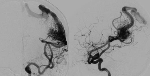 Cerebral angiogram, antero-posterior (left) and lateral (right) revealing a 2.6 × 2.6 × 3.4 cm sulcal type AVM in the left parietal region. Arterial supply is from enlarged parietal and angular branches of the left middle cerebral artery. Venous drainage is superficial into an enlarged vein of Trolard towards the superior sagittal sinus.