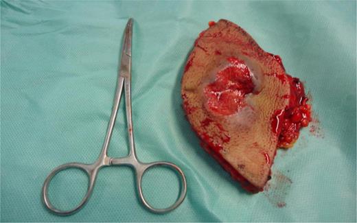 Surgical specimen.