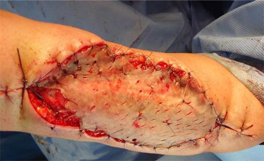 Immediate postoperative.