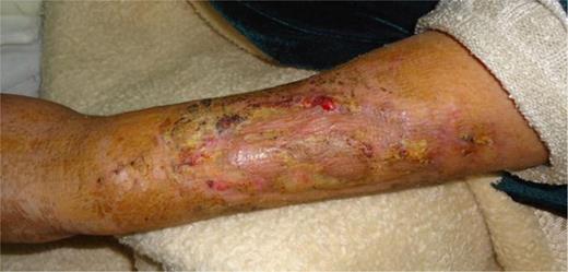 Six months postoperative.